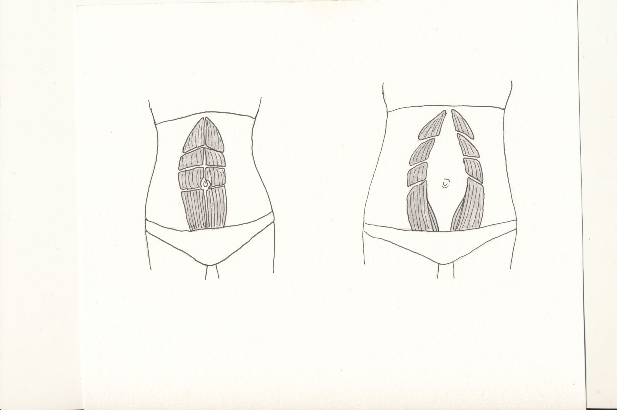 Abdominal Separation - Unzipped: The C Section Project