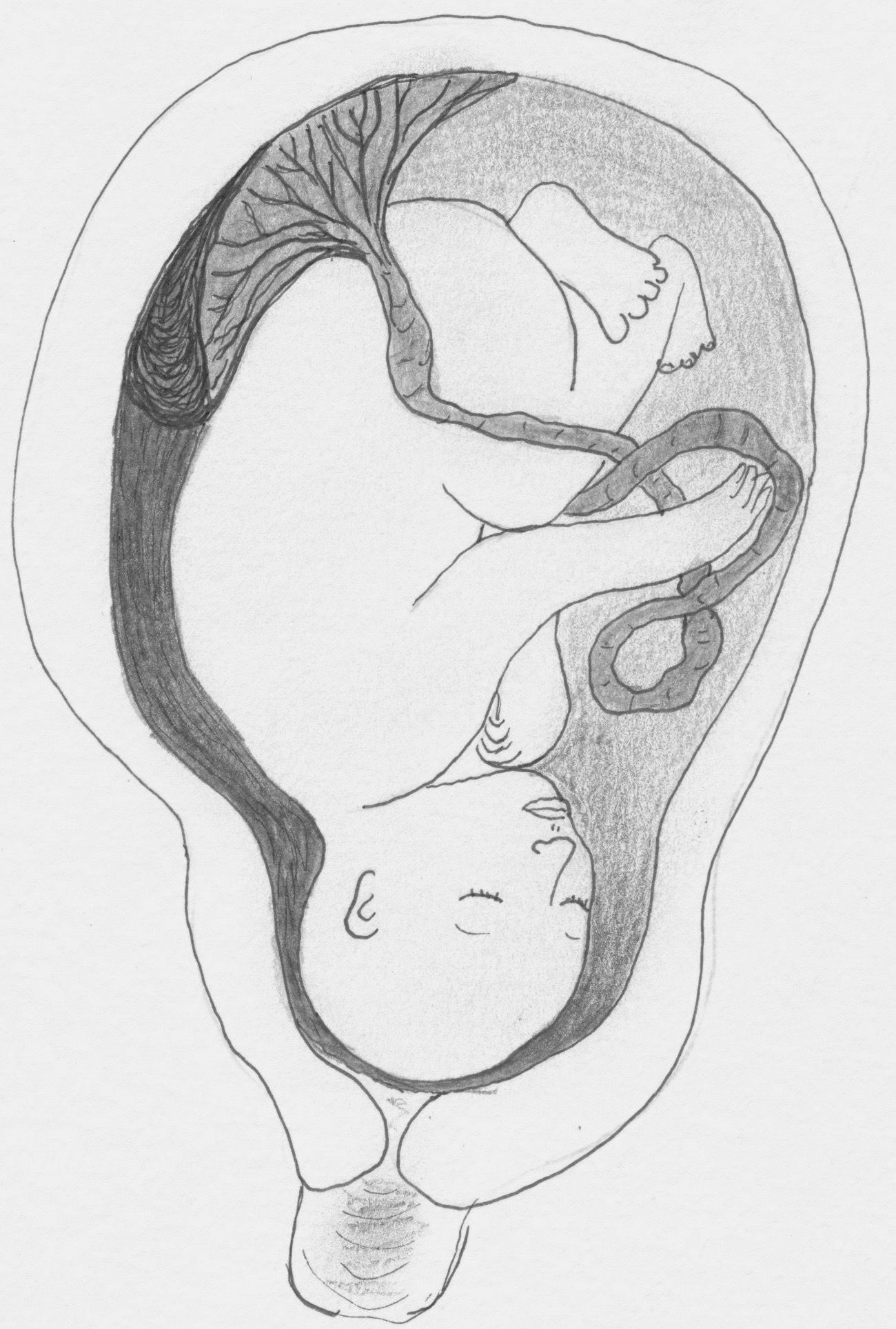 Placental Abruption