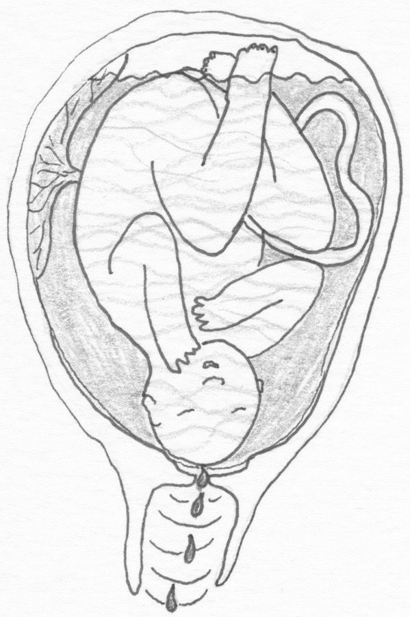 Amniotic Fluid Unzipped The C Section Project